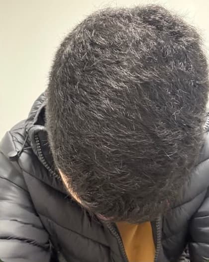 Homem, 26 anos, depois do tratamento capilar